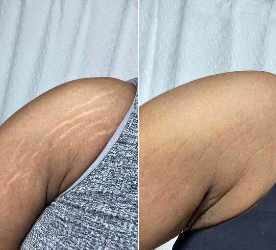 Remove body stretch marks in Bloemfontein +27 81 850 2816