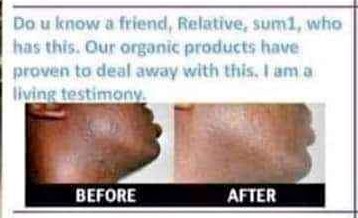 Skin care products for Acne, Scars, blackheads, whiteheads in Randburg, Sasolburg, vanderbiljpark+27 81 850 2816