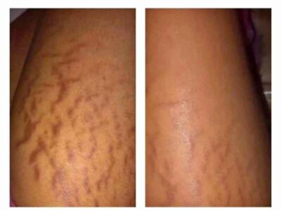 Remove body stretch marks in Bloemfontein +27 81 850 2816