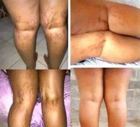 Remove body stretch marks in Bloemfontein +27 81 850 2816