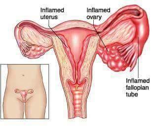 +27 74 676 7021 Vaginal health use, vaginal tightening herbs, vaginal odor herbs in Newcastle
