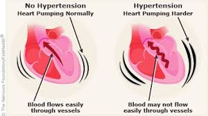 Natural remedy to treat hypertension in Bhisho,Kimberley+27 81 850 2816