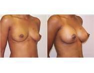 BREASTS FIX AND FIRMING CREAM IN GQEBERHA+27 74 676 7021